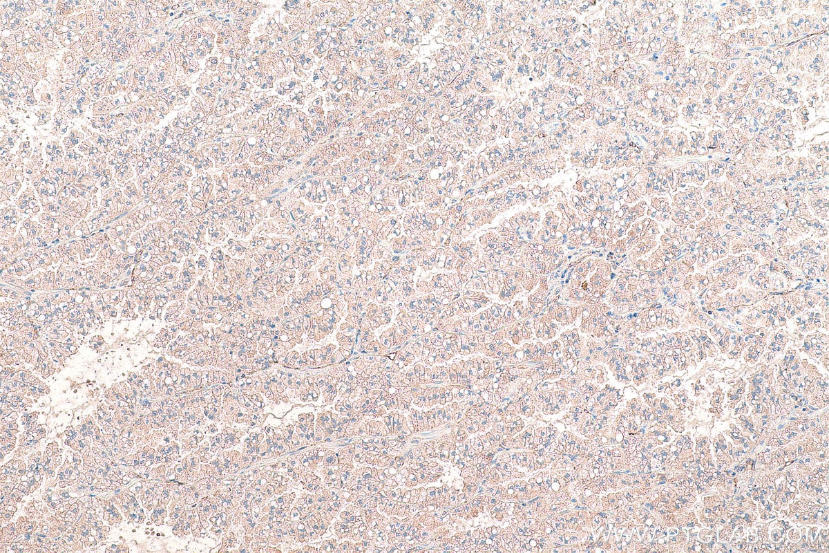 Immunohistochemical analysis of paraffin-embedded human lung cancer tissue slide using KHC0948 (MARCKSL1 IHC Kit).