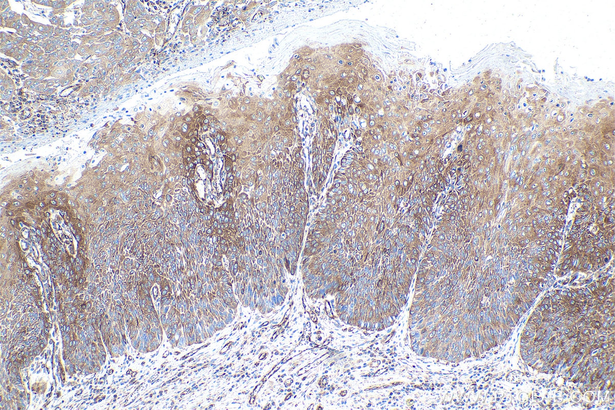 Immunohistochemical analysis of paraffin-embedded human oesophagus cancer tissue slide using KHC1631 (MARS1 IHC Kit).