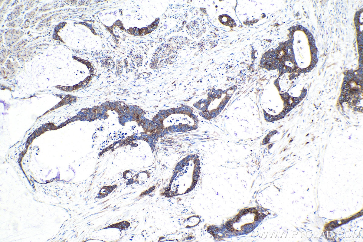 Immunohistochemical analysis of paraffin-embedded human urothelial carcinoma tissue slide using KHC1631 (MARS1 IHC Kit).
