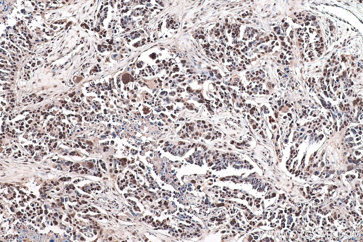 Immunohistochemical analysis of paraffin-embedded human colon cancer tissue slide using KHC0910 (MAT2A IHC Kit).