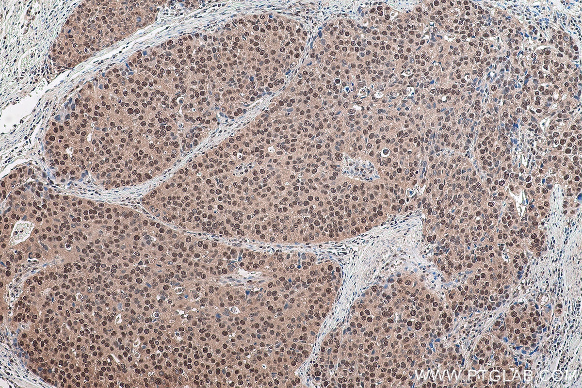 Immunohistochemical analysis of paraffin-embedded human stomach cancer tissue slide using KHC0910 (MAT2A IHC Kit).