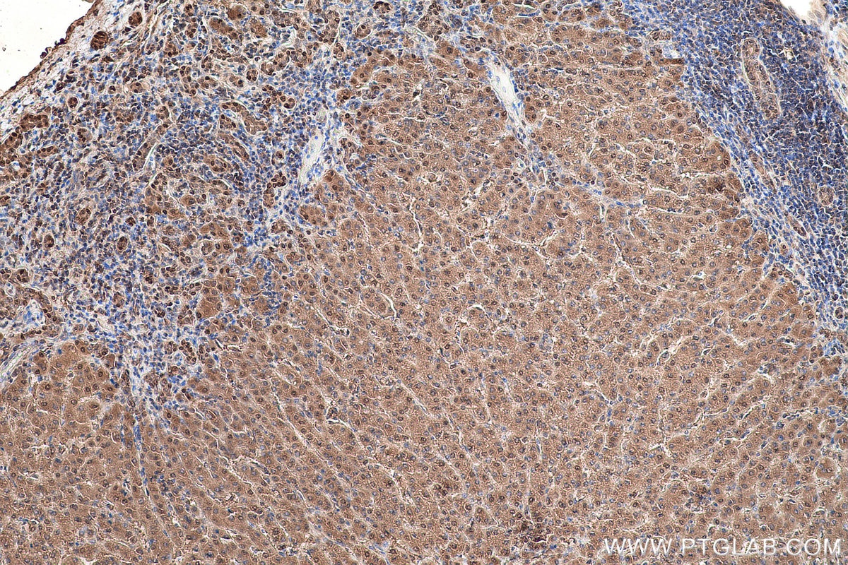 Immunohistochemical analysis of paraffin-embedded human liver cancer tissue slide using KHC0854 (MAT2B IHC Kit).