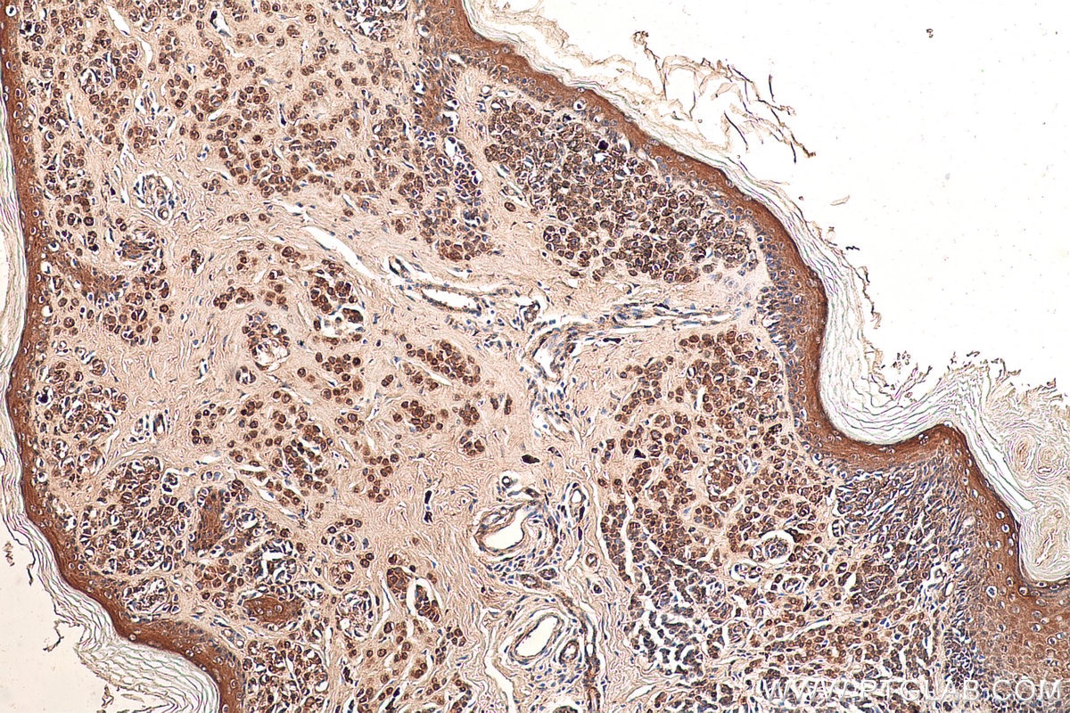 Immunohistochemical analysis of paraffin-embedded human malignant melanoma tissue slide using KHC0854 (MAT2B IHC Kit).