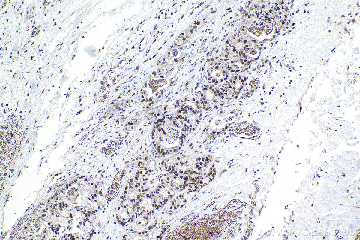 Immunohistochemical analysis of paraffin-embedded human pancreas cancer tissue slide using KHC1641 (MAX IHC Kit).