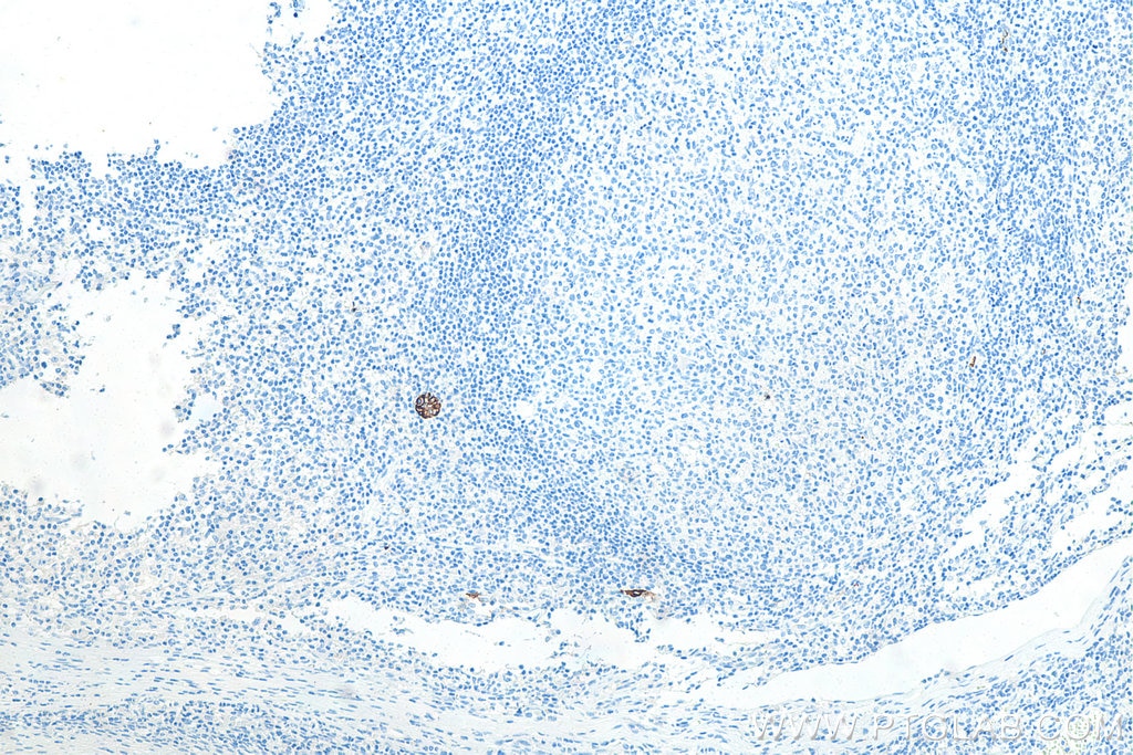 Immunohistochemical analysis of paraffin-embedded human tonsillitis tissue slide using KHC0025 (MAdCAM1 IHC Kit).