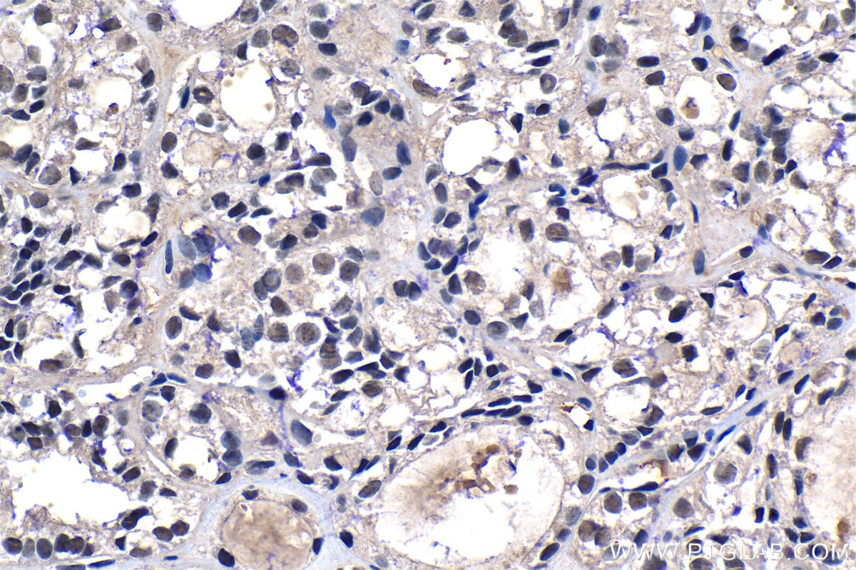 Immunohistochemical analysis of paraffin-embedded human thyroid cancer tissue slide using KHC1309 (MBIP IHC Kit).