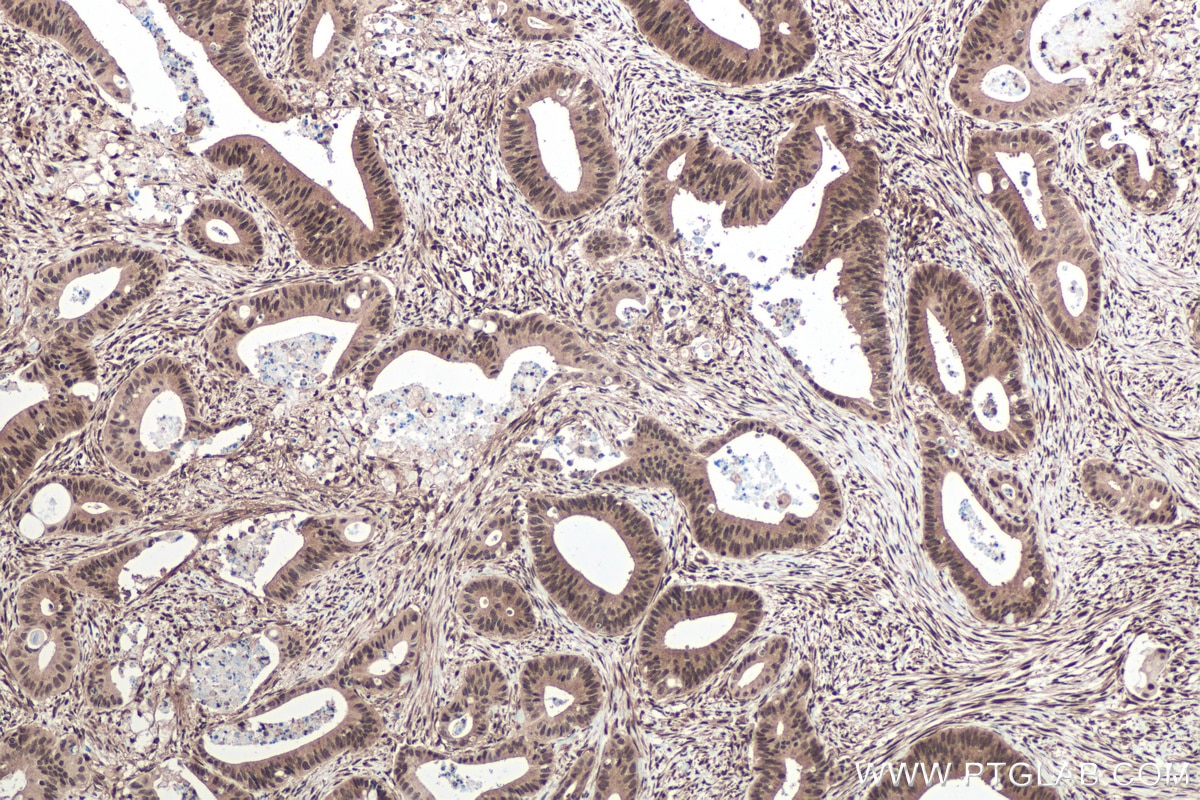 Immunohistochemical analysis of paraffin-embedded human colon cancer tissue slide using KHC0433 (MBNL1 IHC Kit).