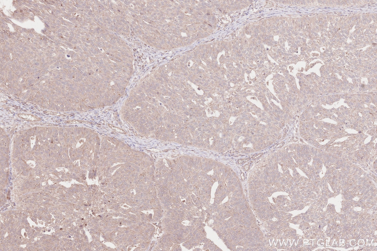 Immunohistochemical analysis of paraffin-embedded human ovary cancer tissue slide using KHC2602 (MBOAT1 IHC Kit).