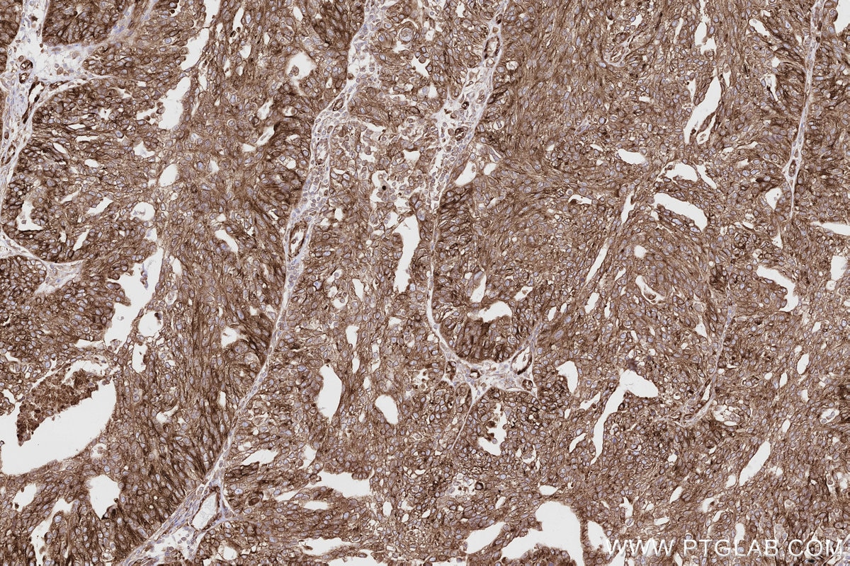 Immunohistochemical analysis of paraffin-embedded human ovary cancer tissue slide using KHC2808 (MBOAT7 IHC Kit).