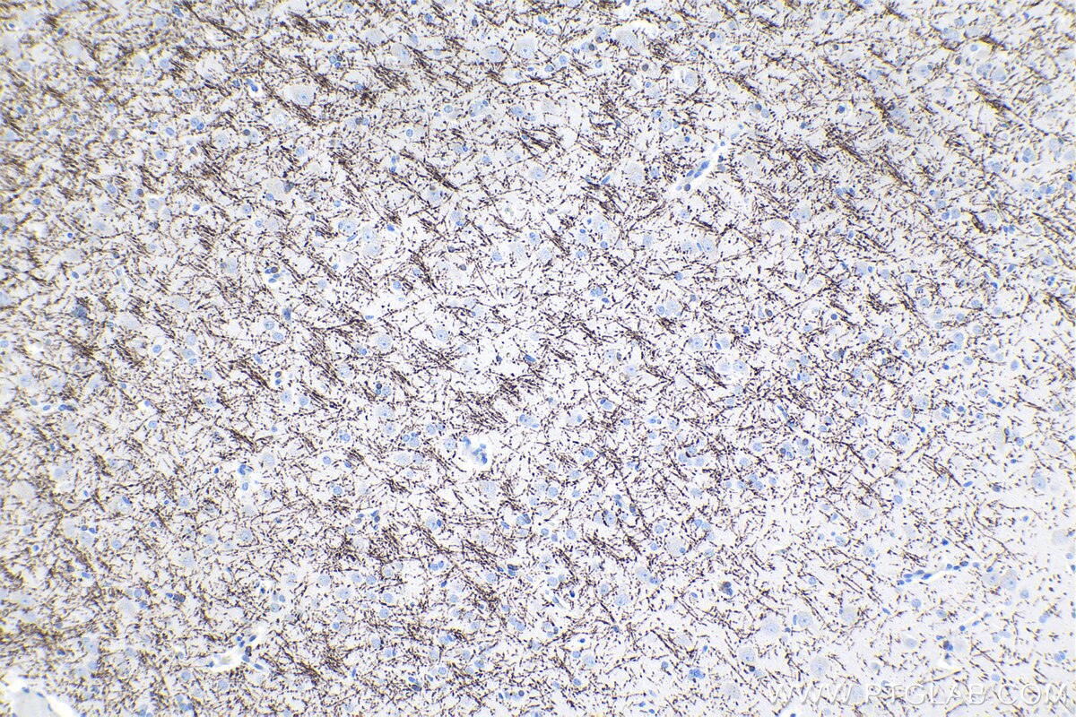 Immunohistochemical analysis of paraffin-embedded human gliomas tissue slide using KHC1504 (MBP IHC Kit).