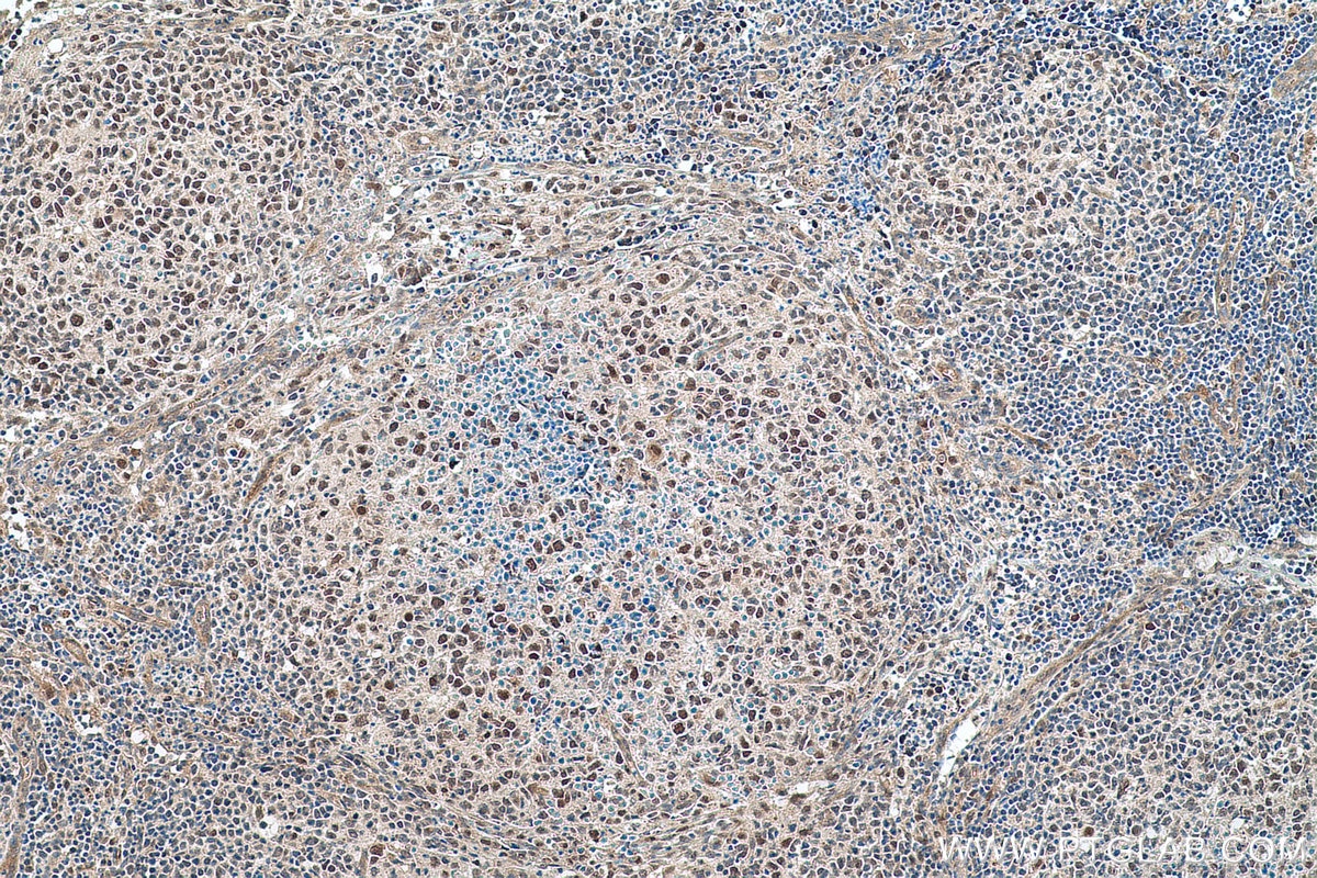 Immunohistochemical analysis of paraffin-embedded human lymphoma tissue slide using KHC0759 (MCC IHC Kit).