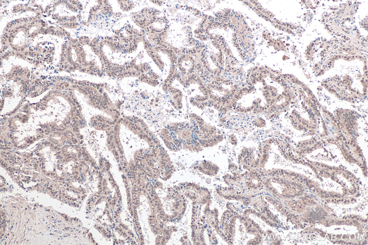 Immunohistochemical analysis of paraffin-embedded human ovary tumor tissue slide using KHC0434 (MCL1 IHC Kit).