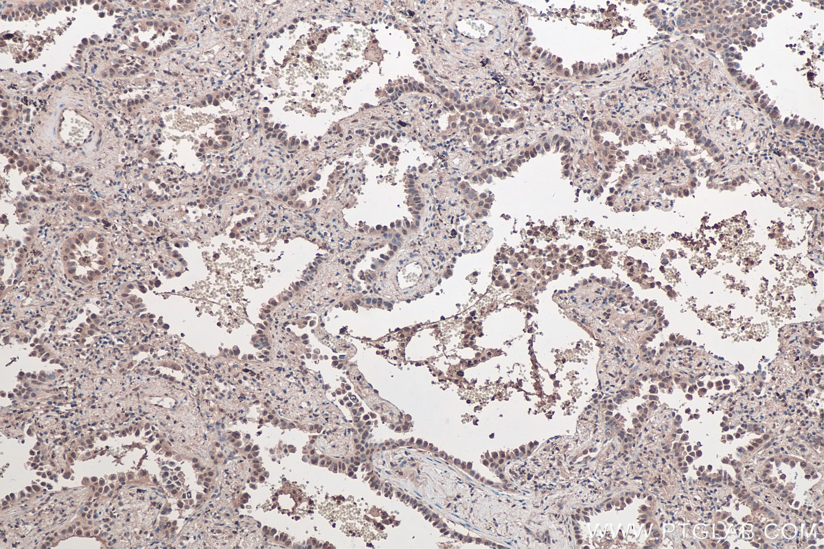Immunohistochemical analysis of paraffin-embedded human lung cancer tissue slide using KHC0434 (MCL1 IHC Kit).