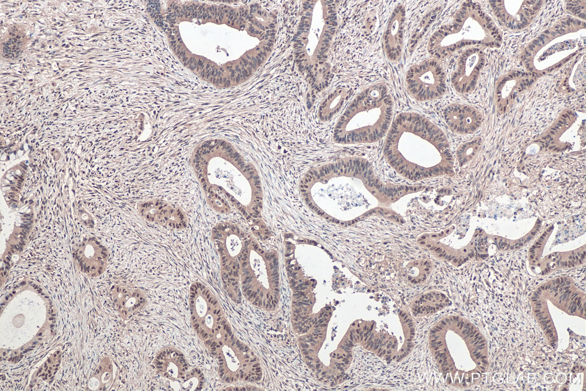 Immunohistochemical analysis of paraffin-embedded human colon cancer tissue slide using KHC0434 (MCL1 IHC Kit).