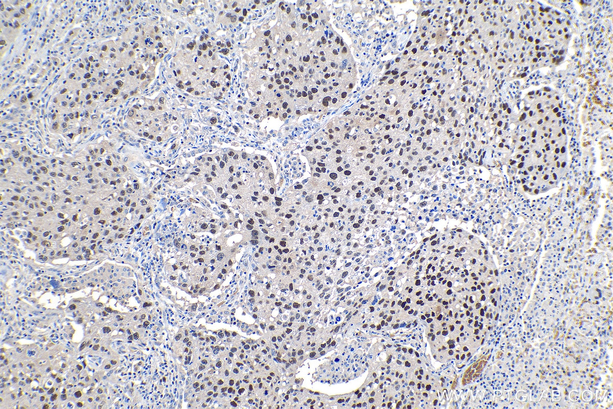 Immunohistochemical analysis of paraffin-embedded human lung cancer tissue slide using KHC1209 (MCM2 IHC Kit).