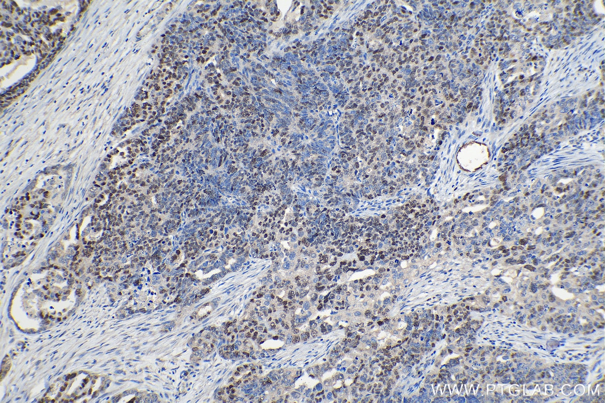 Immunohistochemical analysis of paraffin-embedded human ovary tumor tissue slide using KHC1209 (MCM2 IHC Kit).