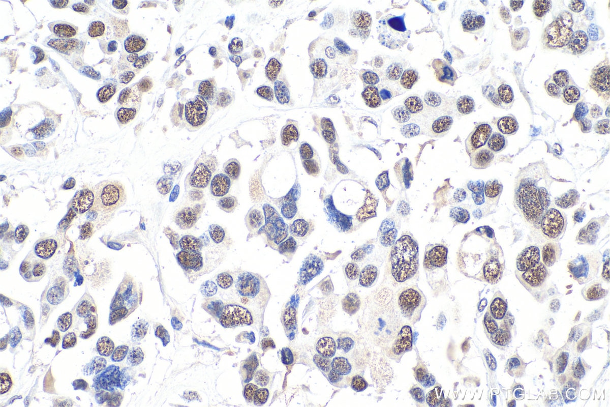 Immunohistochemical analysis of paraffin-embedded human colon cancer tissue slide using KHC0915 (MCM3 IHC Kit).