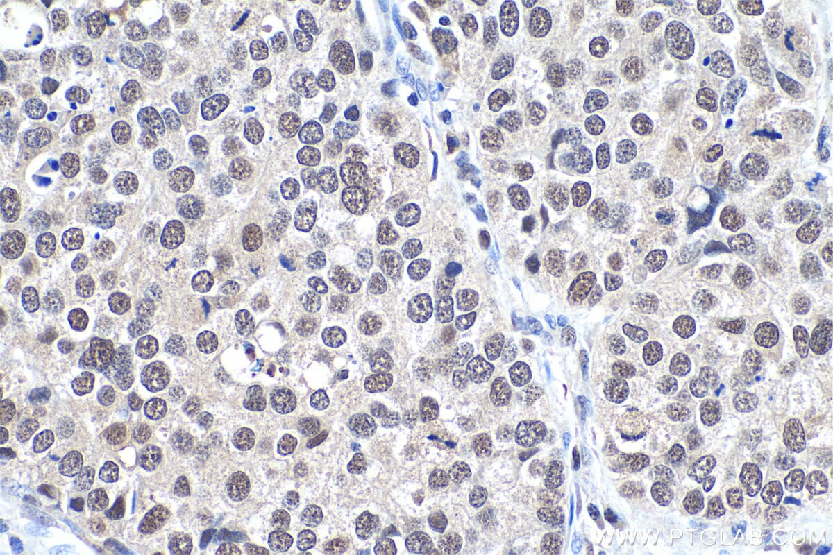 Immunohistochemical analysis of paraffin-embedded human stomach cancer tissue slide using KHC0915 (MCM3 IHC Kit).