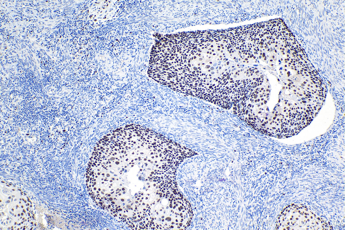 Immunohistochemical analysis of paraffin-embedded human cervical cancer tissue slide using KHC1028 (MCM4 IHC Kit).