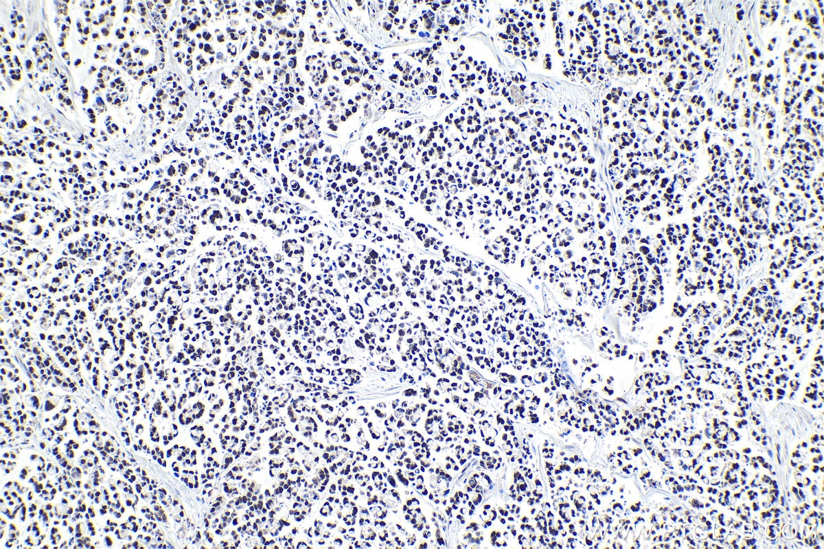 Immunohistochemical analysis of paraffin-embedded human colon cancer tissue slide using KHC1029 (MCM5 IHC Kit).