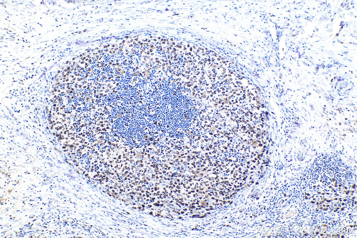 Immunohistochemical analysis of paraffin-embedded human lymphoma tissue slide using KHC1029 (MCM5 IHC Kit).