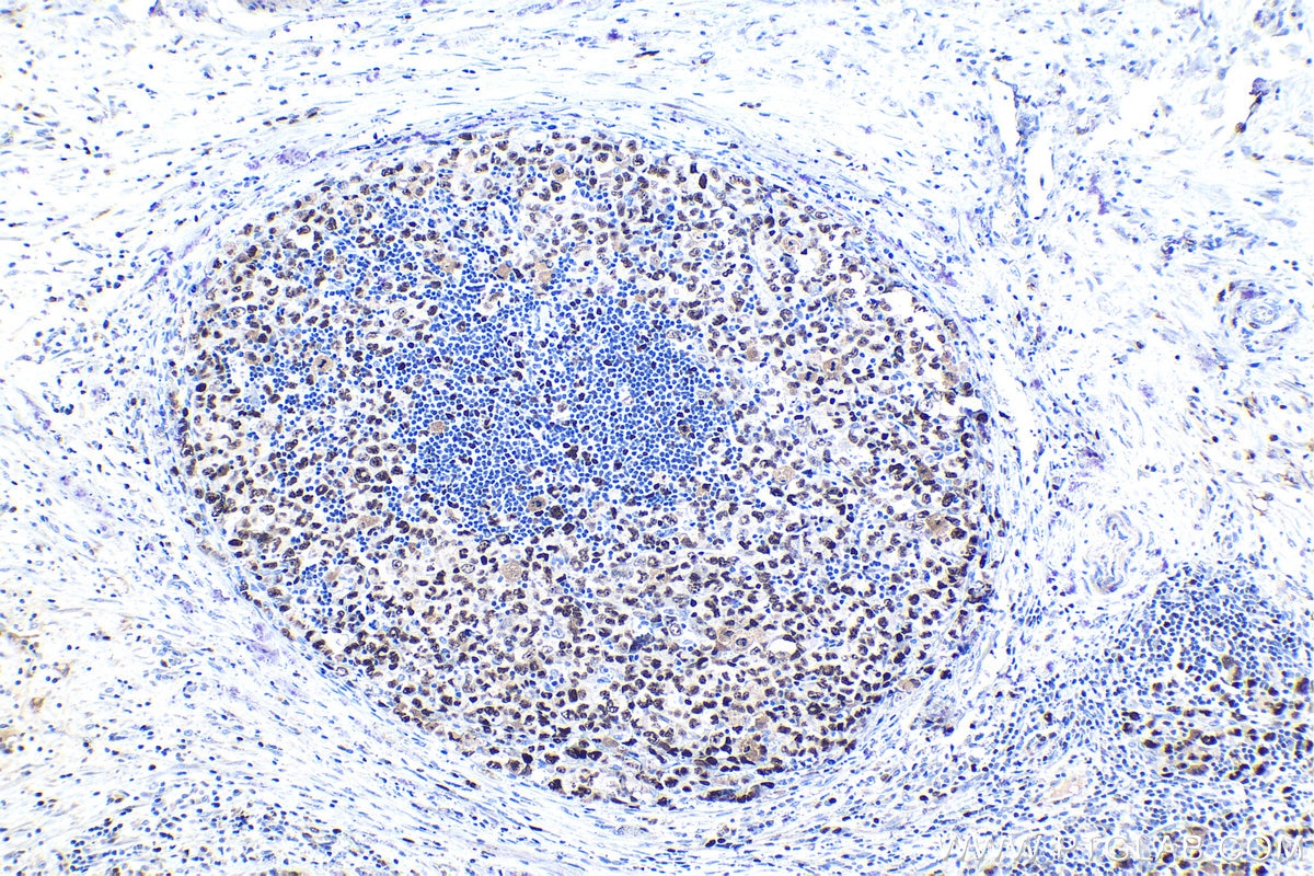 Immunohistochemical analysis of paraffin-embedded human lymphoma tissue slide using KHC1029 (MCM5 IHC Kit).