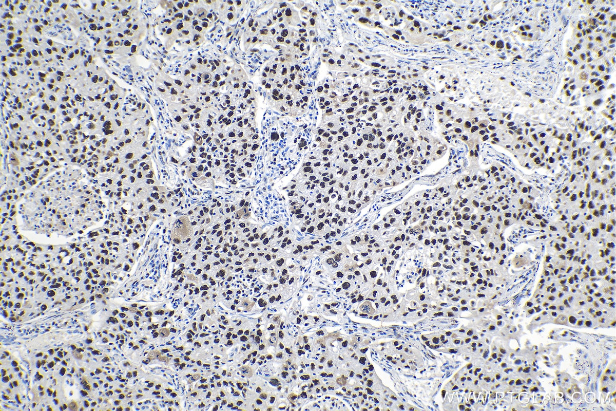 Immunohistochemical analysis of paraffin-embedded human lung cancer tissue slide using KHC1325 (MCM6 IHC Kit).