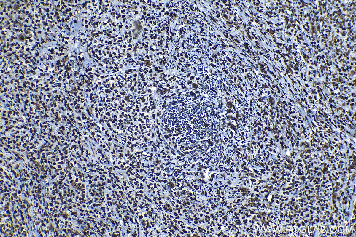 Immunohistochemical analysis of paraffin-embedded human lymphoma tissue slide using KHC1325 (MCM6 IHC Kit).