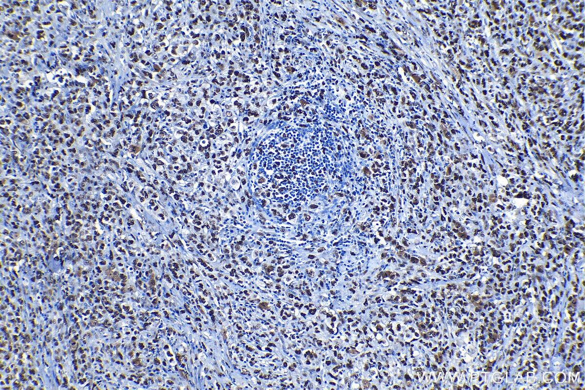 Immunohistochemical analysis of paraffin-embedded human lymphoma tissue slide using KHC1324 (MCM7 IHC Kit).