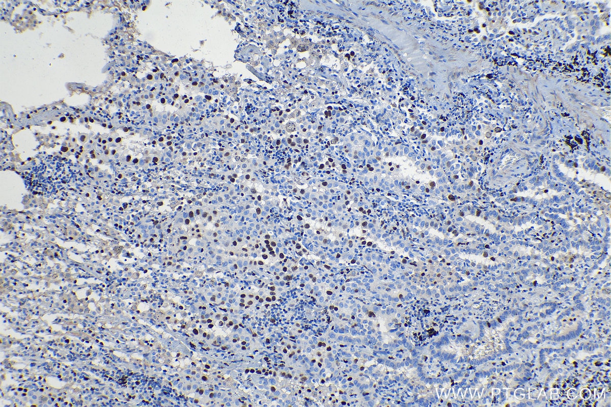 Immunohistochemical analysis of paraffin-embedded human lung cancer tissue slide using KHC1324 (MCM7 IHC Kit).