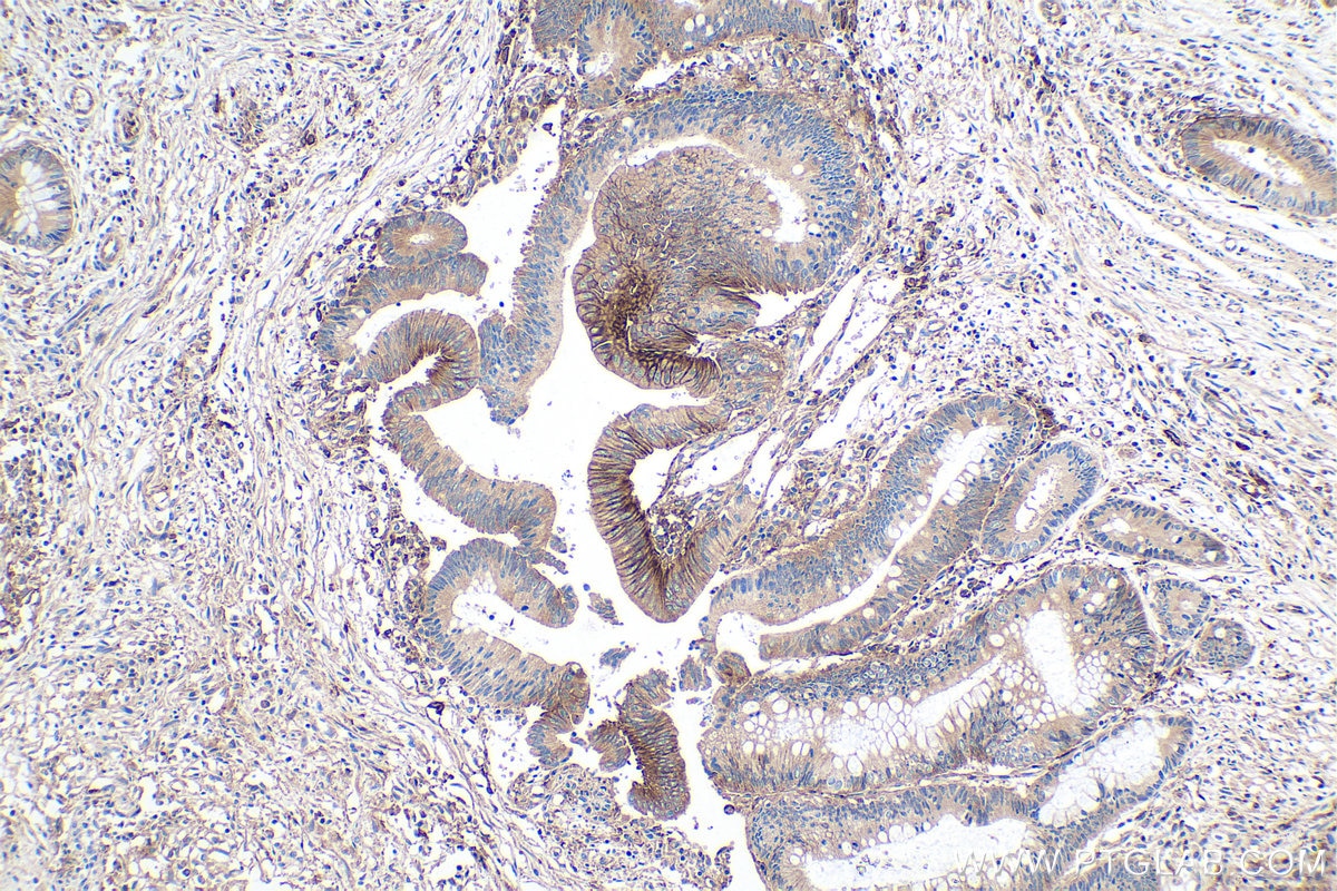 Immunohistochemical analysis of paraffin-embedded human colon cancer tissue slide using KHC0133 (MCT4 IHC Kit).