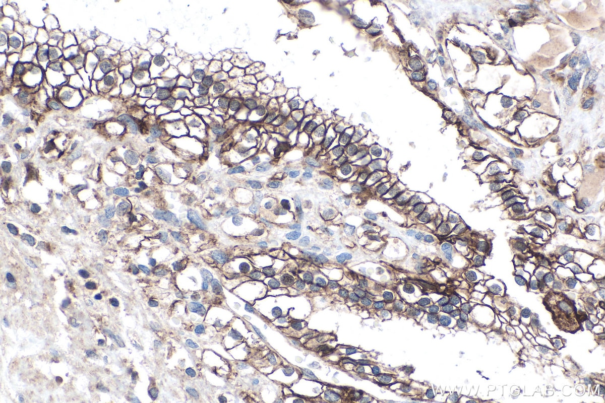 Immunohistochemical analysis of paraffin-embedded human renal cell carcinoma tissue slide using KHC0133 (MCT4 IHC Kit).