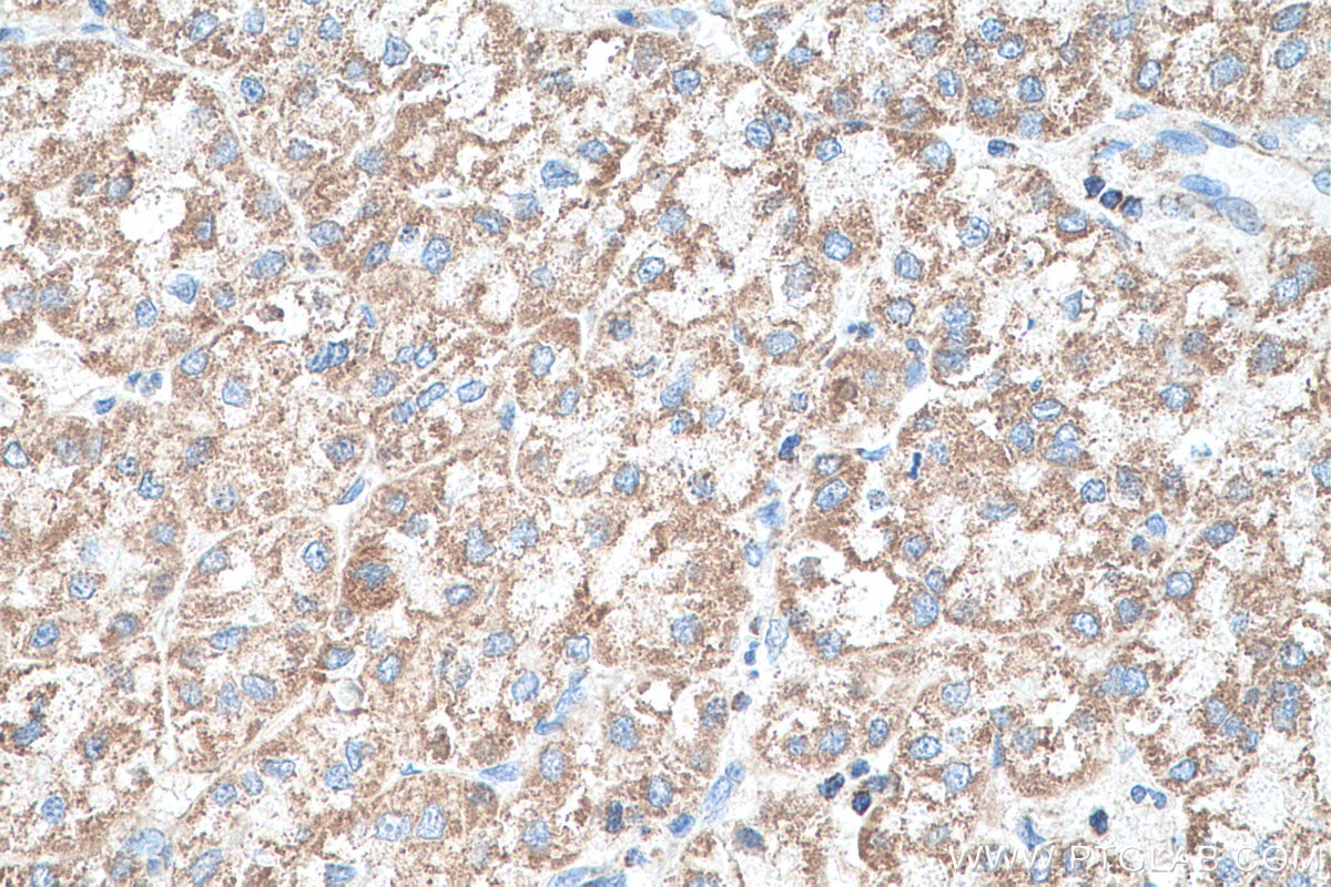 Immunohistochemical analysis of paraffin-embedded human liver cancer tissue slide using KHC0524 (MDH2 IHC Kit).