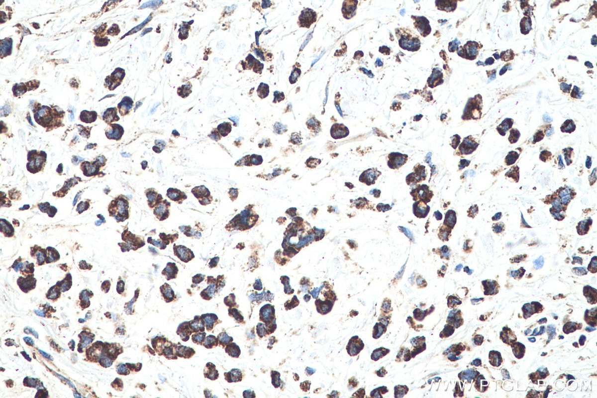 Immunohistochemical analysis of paraffin-embedded human stomach cancer tissue slide using KHC0524 (MDH2 IHC Kit).