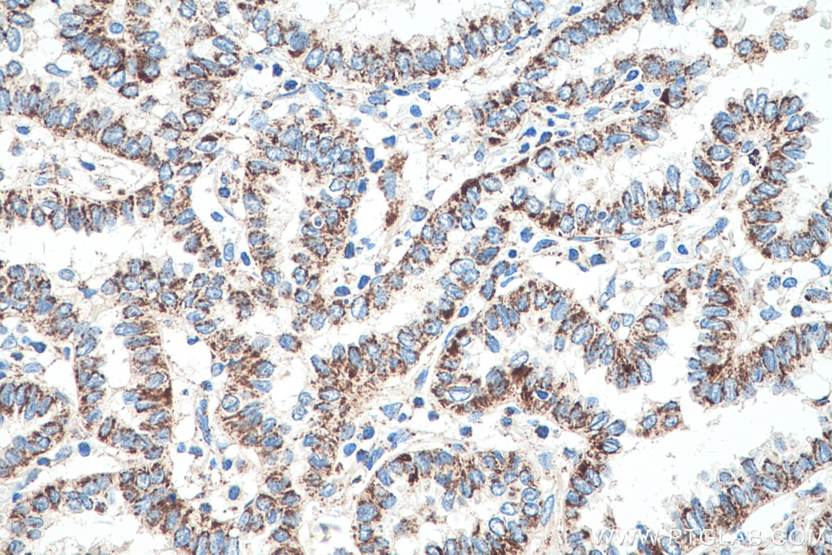 Immunohistochemical analysis of paraffin-embedded human lung cancer tissue slide using KHC0524 (MDH2 IHC Kit).