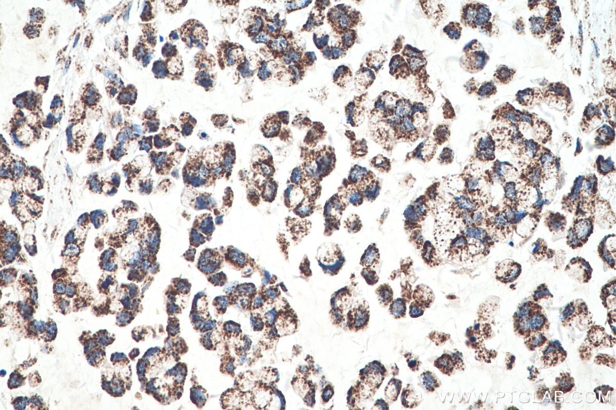 Immunohistochemical analysis of paraffin-embedded human colon cancer tissue slide using KHC0524 (MDH2 IHC Kit).