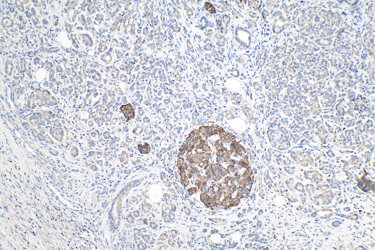 Immunohistochemical analysis of paraffin-embedded human pancreas cancer tissue slide using KHC0213 (Midkine IHC Kit).