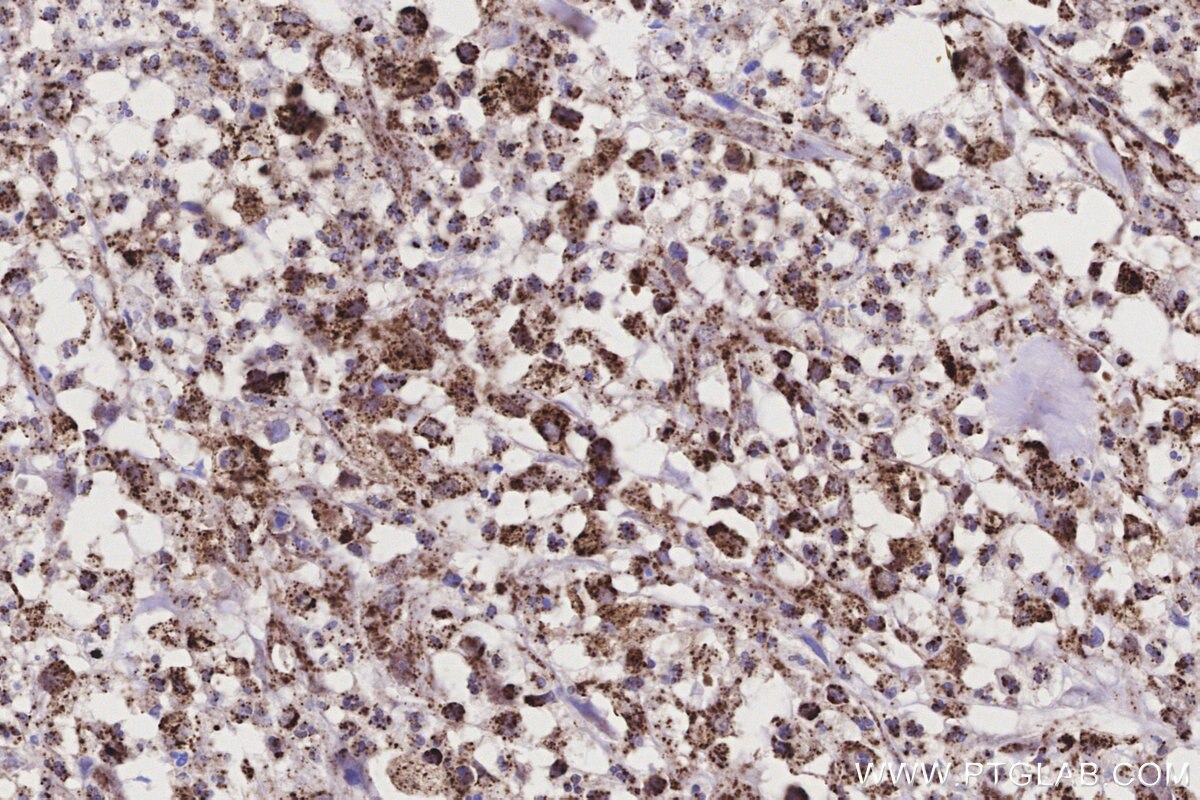 Immunohistochemical analysis of paraffin-embedded human colon cancer tissue slide using KHC3199 (ME2 IHC Kit).