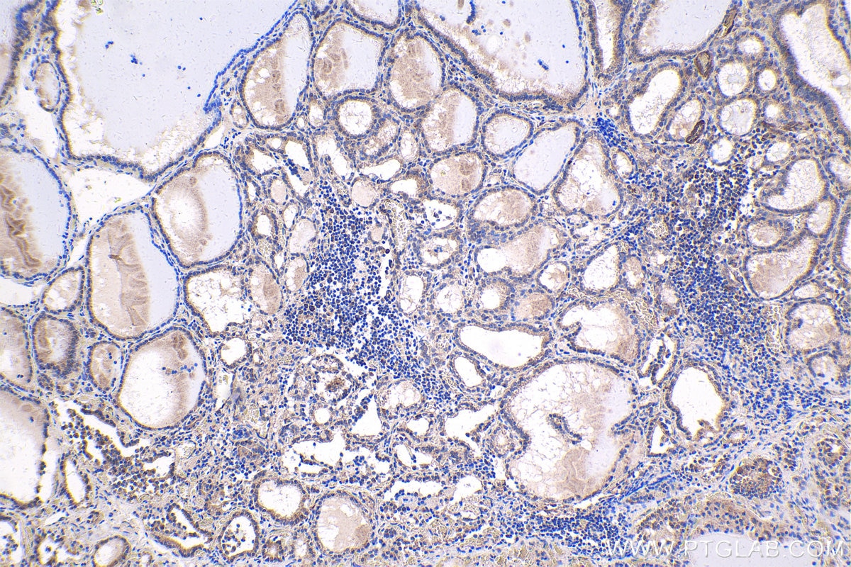 Immunohistochemical analysis of paraffin-embedded human thyroid cancer tissue slide using KHC1680 (MEF2C IHC Kit).