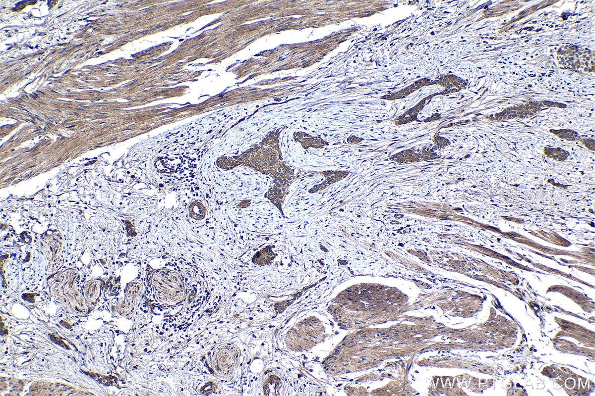 Immunohistochemical analysis of paraffin-embedded human urothelial carcinoma tissue slide using KHC1261 (MEI1 IHC Kit).