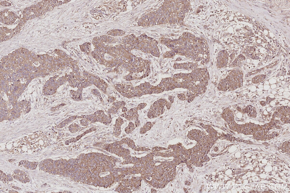 Immunohistochemical analysis of paraffin-embedded human stomach cancer tissue slide using KHC3058 (MEKK2 IHC Kit). Immunohistochemical analysis of paraffin-embedded human stomach cancer tissue slide using KHC3058 (MEKK2 IHC Kit).