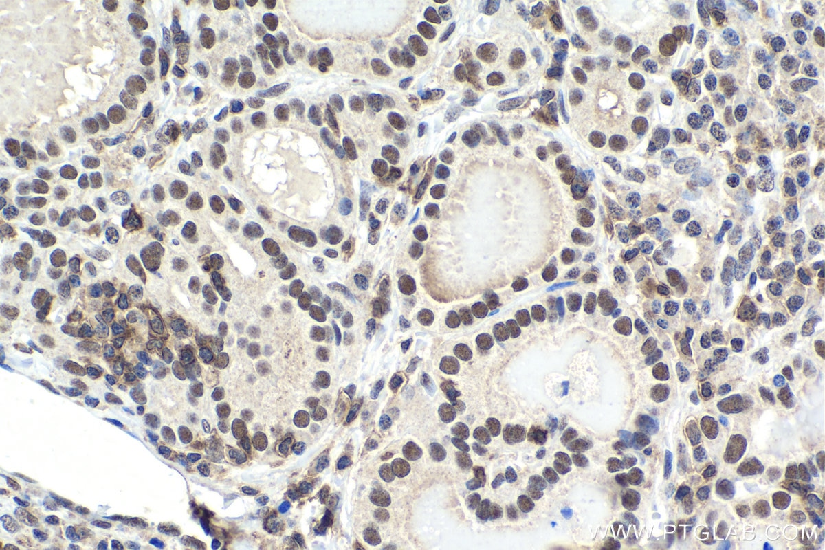 Immunohistochemical analysis of paraffin-embedded human thyroid cancer tissue slide using KHC1797 (MEPCE IHC Kit).