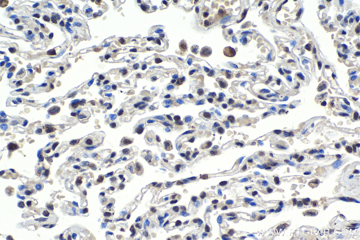 Immunohistochemical analysis of paraffin-embedded human lung cancer tissue slide using KHC1797 (MEPCE IHC Kit).