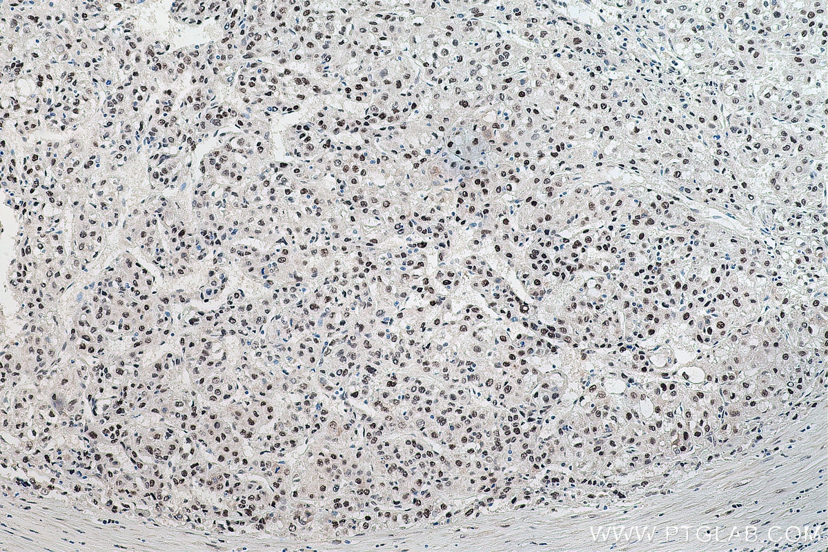 Immunohistochemical analysis of paraffin-embedded human liver cancer tissue slide using KHC0144 (METTL1 IHC Kit).