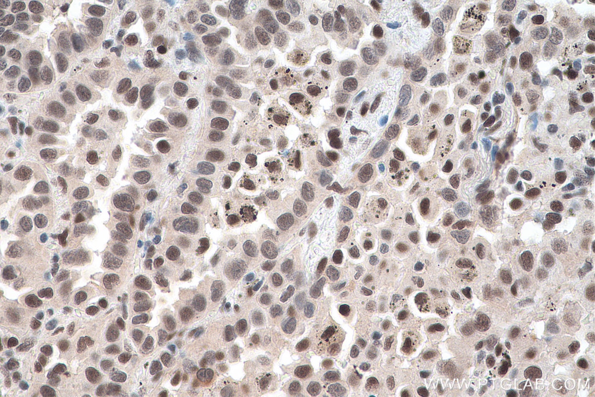 Immunohistochemical analysis of paraffin-embedded human lung cancer tissue slide using KHC0144 (METTL1 IHC Kit).