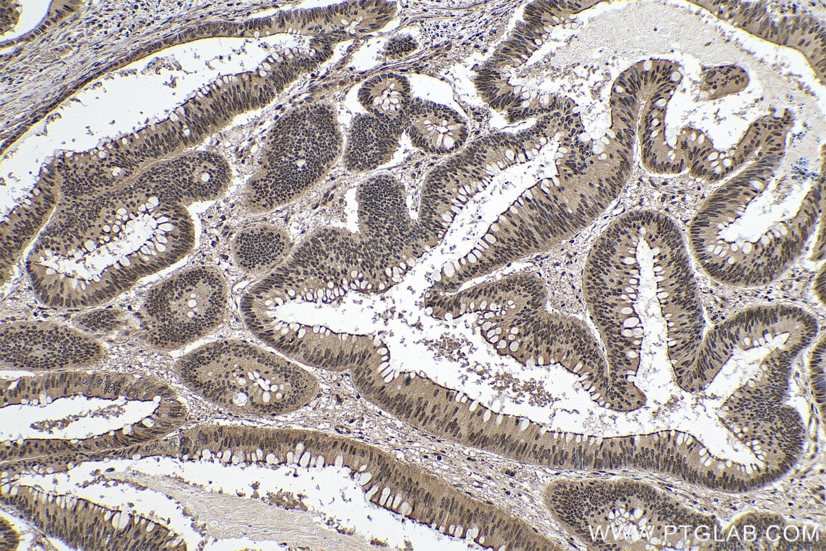 Immunohistochemical analysis of paraffin-embedded human colon cancer tissue slide using KHC0145 (METTL14 IHC Kit).