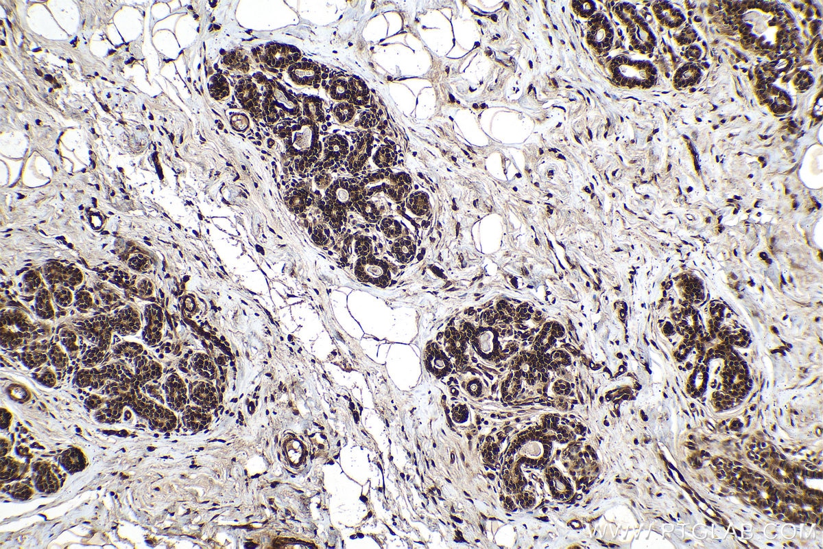 Immunohistochemical analysis of paraffin-embedded human breast cancer tissue slide using KHC0145 (METTL14 IHC Kit).