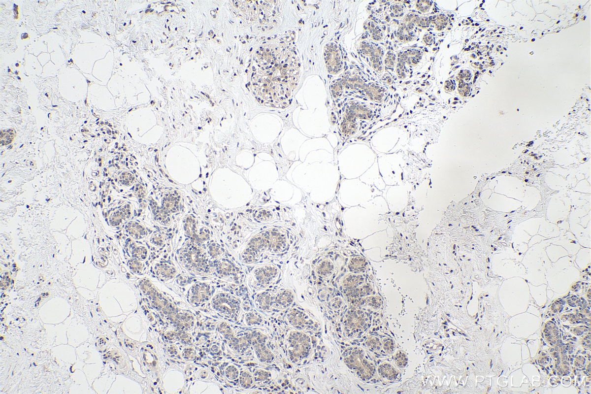Immunohistochemical analysis of paraffin-embedded human breast cancer tissue slide using KHC0146 (METTL16 IHC Kit).