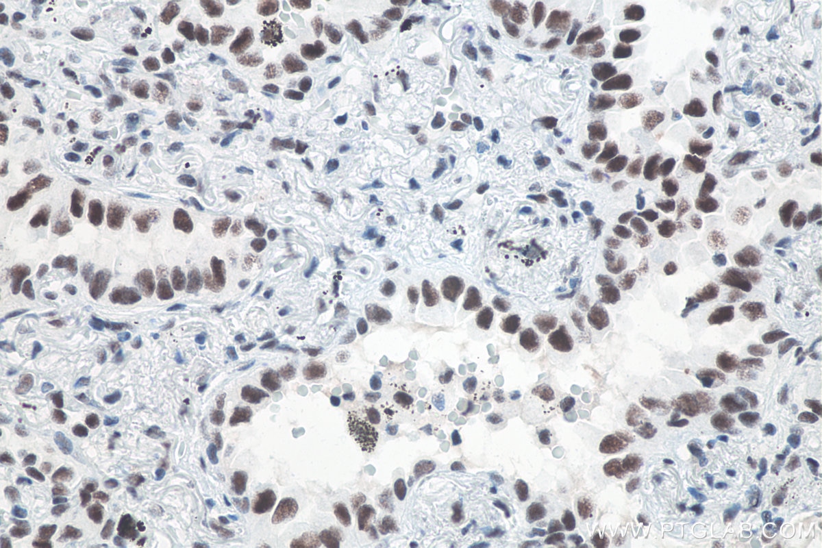 Immunohistochemical analysis of paraffin-embedded human lung cancer tissue slide using KHC0061 (METTL3 IHC Kit).