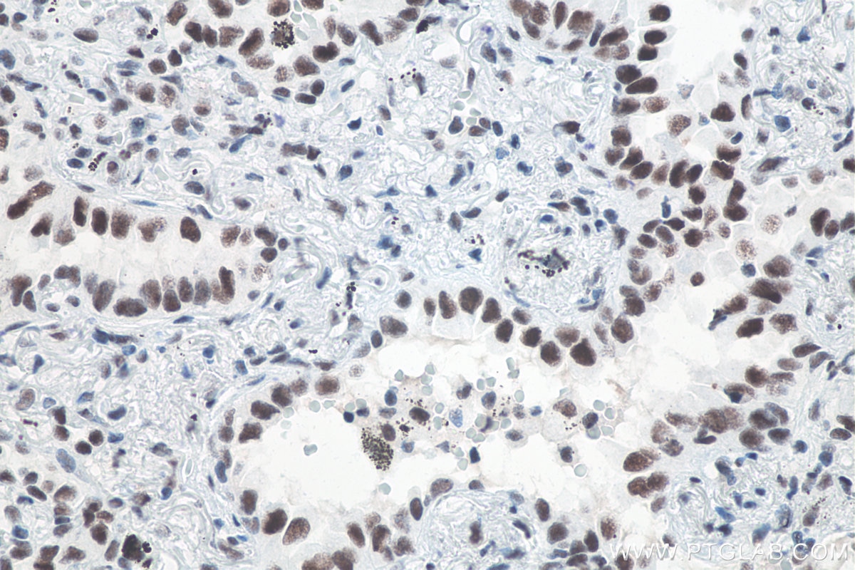 Immunohistochemical analysis of paraffin-embedded human lung cancer tissue slide using KHC0061 (METTL3 IHC Kit).